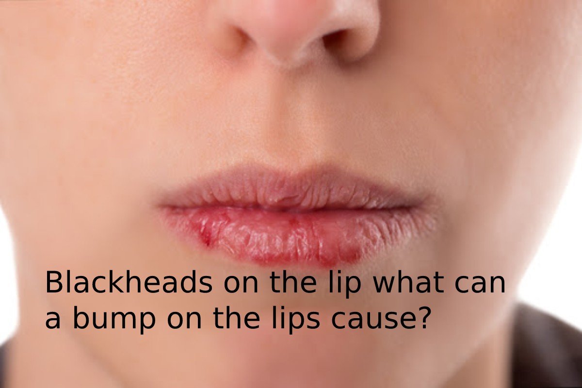 Blackheads on the lip what can a bump on the lips cause?