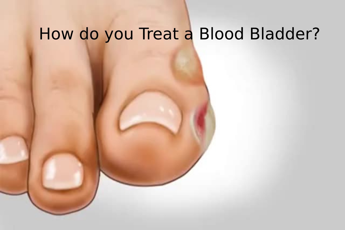 How do you Treat a Blood Bladder?