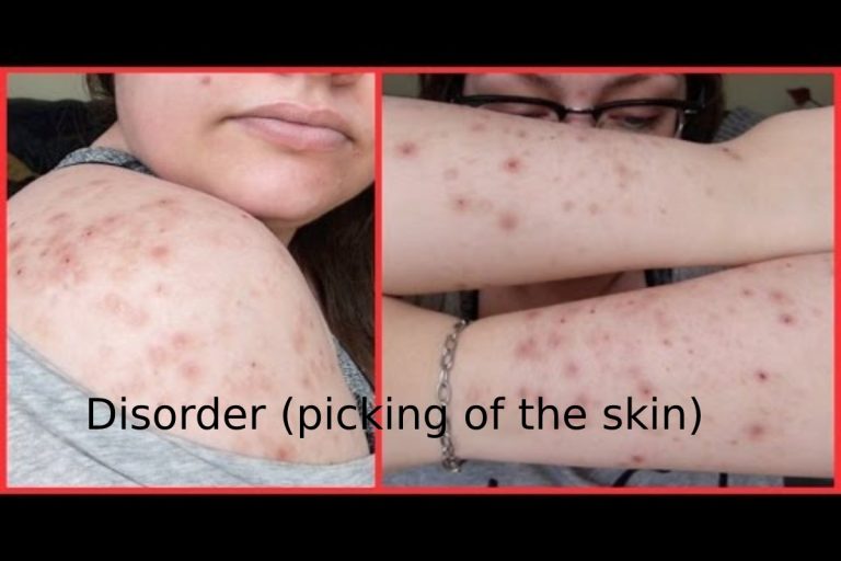 Disorder (picking of the skin)