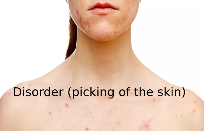 Disorder (picking of the skin)