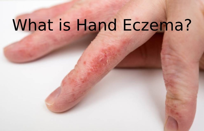Hand Eczema 