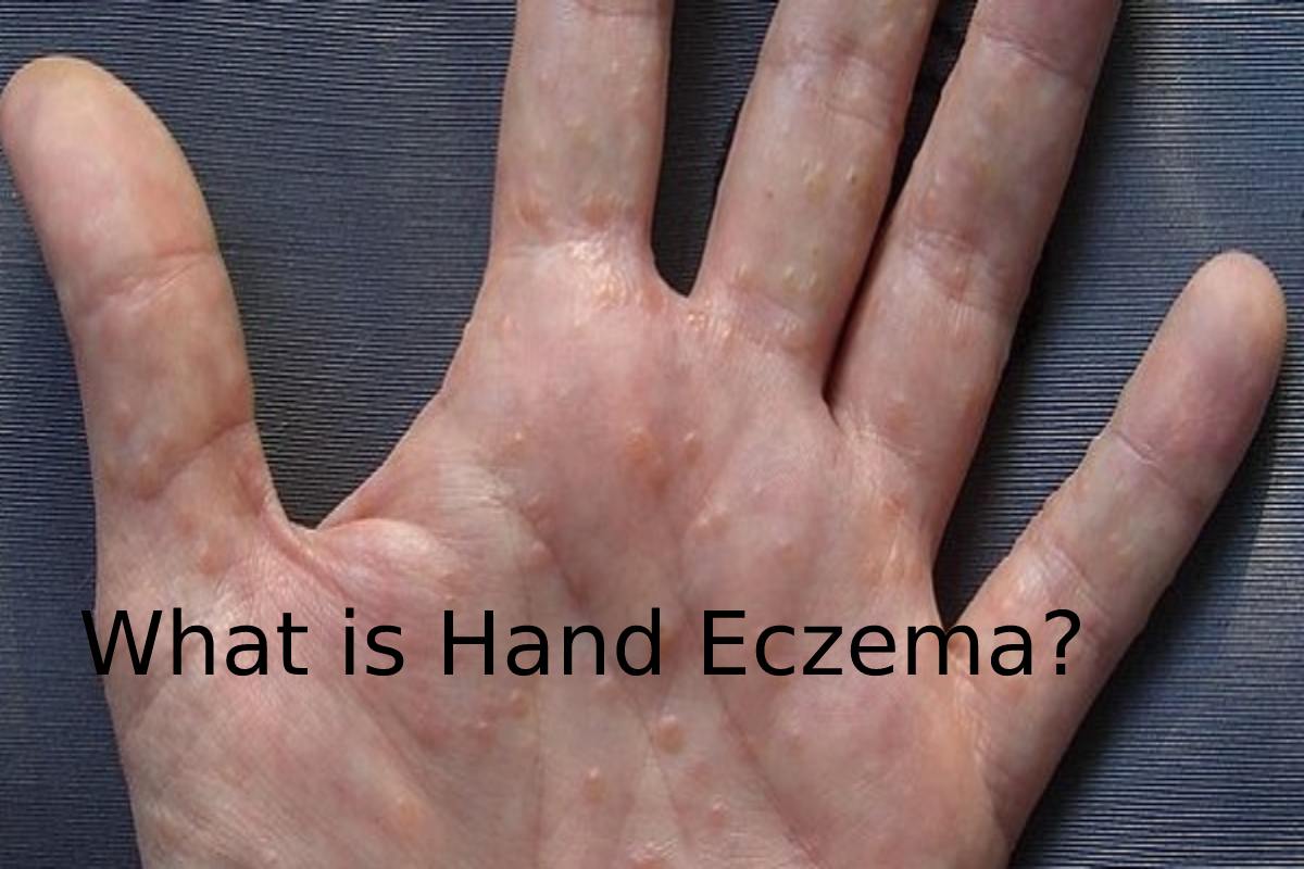 What is Hand Eczema? – Produced, Treatment, and More
