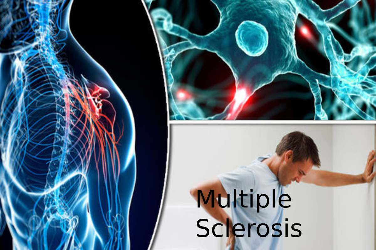 What is Multiple Sclerosis? – Types, Disease, Symptoms, and More