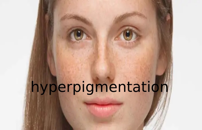hyperpigmentation