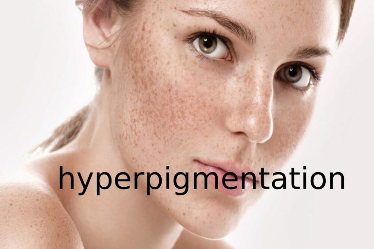 hyperpigmentation