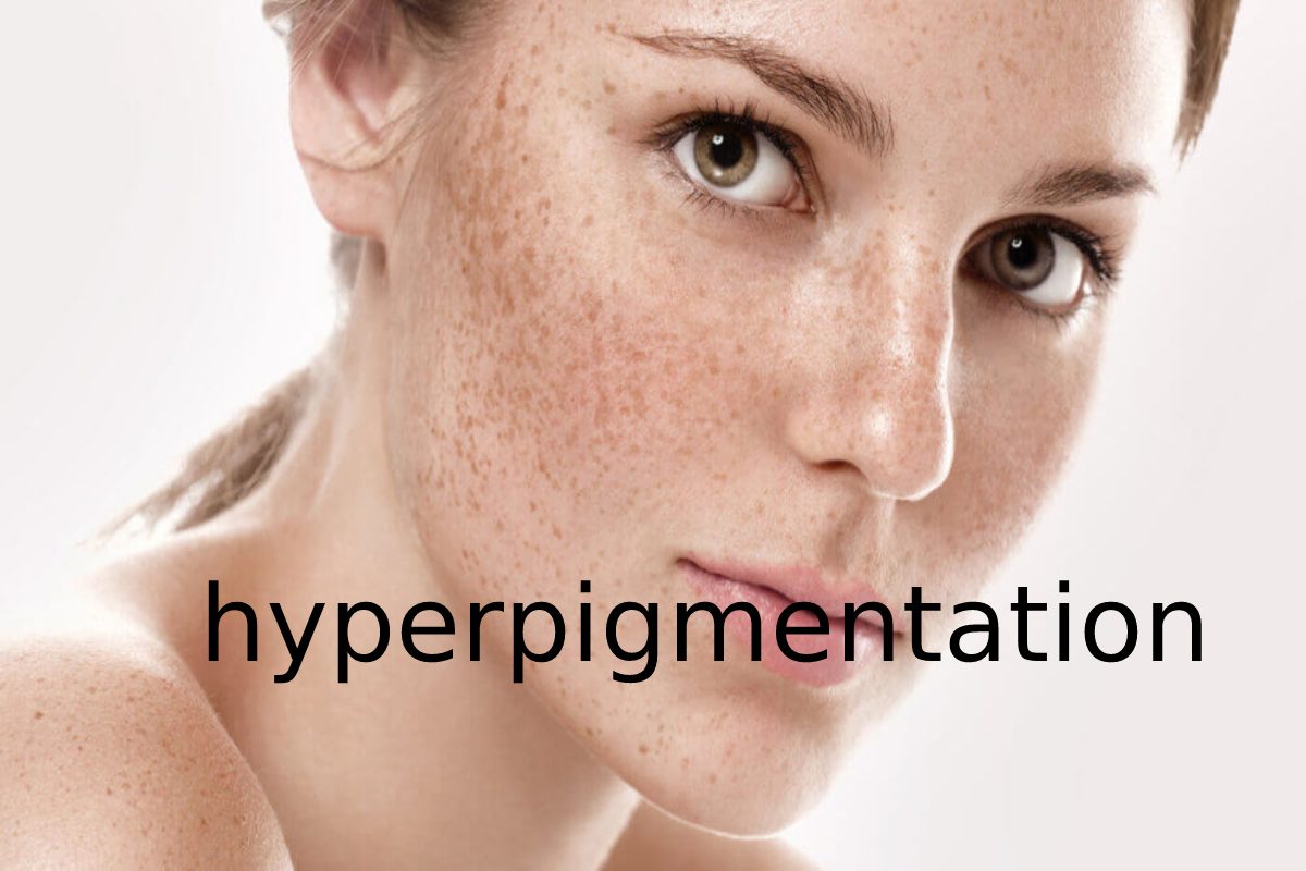 How To Treat Hyperpigmentation Of The Skin Naturally