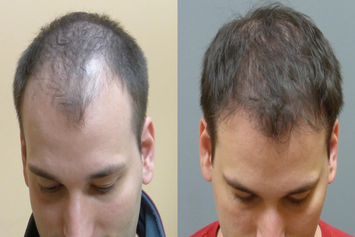 Hair Restoration: Things You Need To Know Before