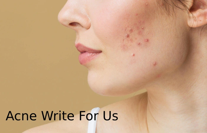 acne write for us