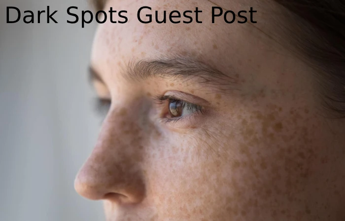 Dark Spots Guest Post