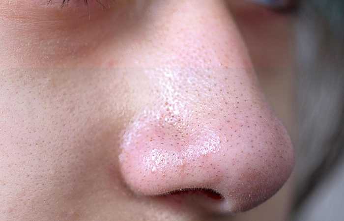 Blackhead Write For Us, Guest Post, Contribute, And Submit Post